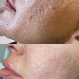 سابسیژن (رفع جای جوش و اسکار) اقتصادی