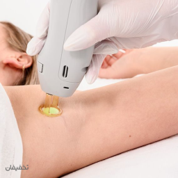 لیزر موهای زائد ویژه دو زیر بغل در کلینیک دکتر لیزر