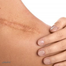 رفع لک روی شکم و کمر در کلینیک دکتر لیزر
