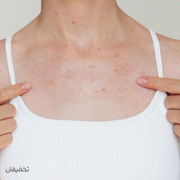 رفع جای سوختگی و جوش قفسه سینه در کلینیک دکتر لیزر