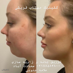 تزریق ژل و فیلر گونه ،چونه، خط خنده، زاویه