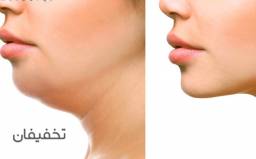 مزوتراپی رفع غبغب