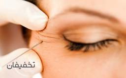 بوتاکس در مطب دکتر سالاری فر
