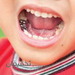 عصب کشی دندان های شیری اطفال به همراه روکش فلزی استیل در مطب دکتر صادقی