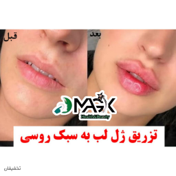 بوتاکس با قیمت باورنکردنی