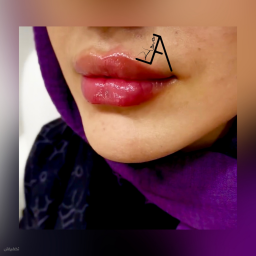 تزریق ژل لب