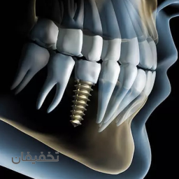 ايمپلنت برتر سوييس