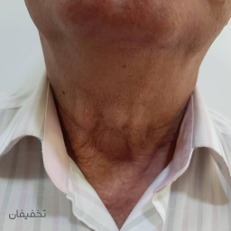 هایفوتراپی