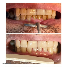 جرمگيري و بروساژ دو فك