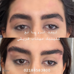 لیفت ابرو با نخ کلاژن