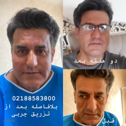 تزریق چربی به کل صورت