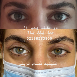 عمل پلک بلفاروپلاستی