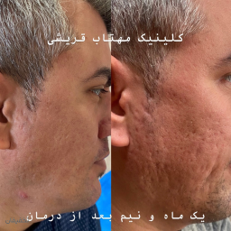 درمان تضمینی جای جوش