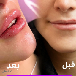 تزریق فیلر لب نورامیس