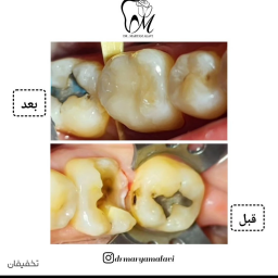 ترمیم دندان (پرکردن) با تخفیف ویژه