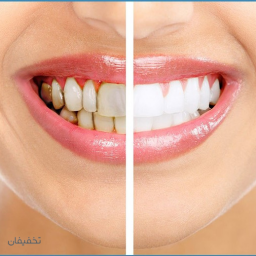 جرم گیری کامل هر فک (دندان و زیر لثه) (توسط جراح دندانپزشک دکتر حوریه جنیدی)