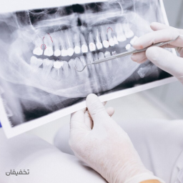 روکش زیرکونیا (تمام سرامیک)