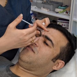 تزریق انواع فیلر