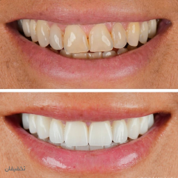 بلیچینگ آفیس در مطب