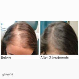 پی آر پی مو با تخفیف ویژه همیشگی