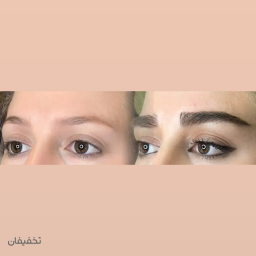 کاشت ابرو تخصصی