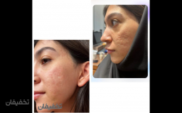 اگزوزوم تراپی