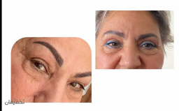 تزریق بوتاکس