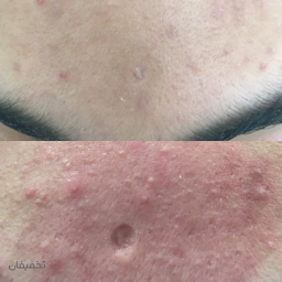 میکرونیدلینگ و مزونیدلینگ