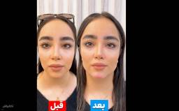 فیلر کانتورینگ صورت