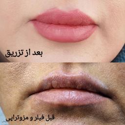 مزور تراپی و تزریق فیلر لب