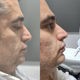 اصلاح فرم بینی