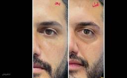 فیلر زیر چشم