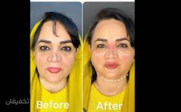 لیفت با نخ کاگ کرهای