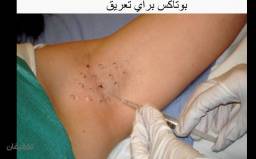 بوتاکس زیر بغل