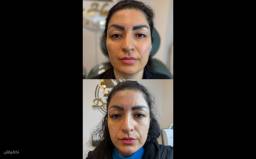 ژل و بوتاکس توسط پزشک