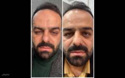 جوانسازی و رفع چین و چروک صورت
