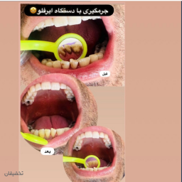 جرمگیری با دستگاه ایرفلو