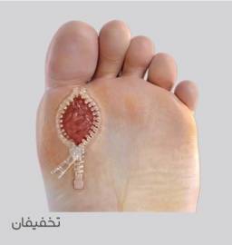 میترا غفارپور درمانگر تخصصی انواع زخم