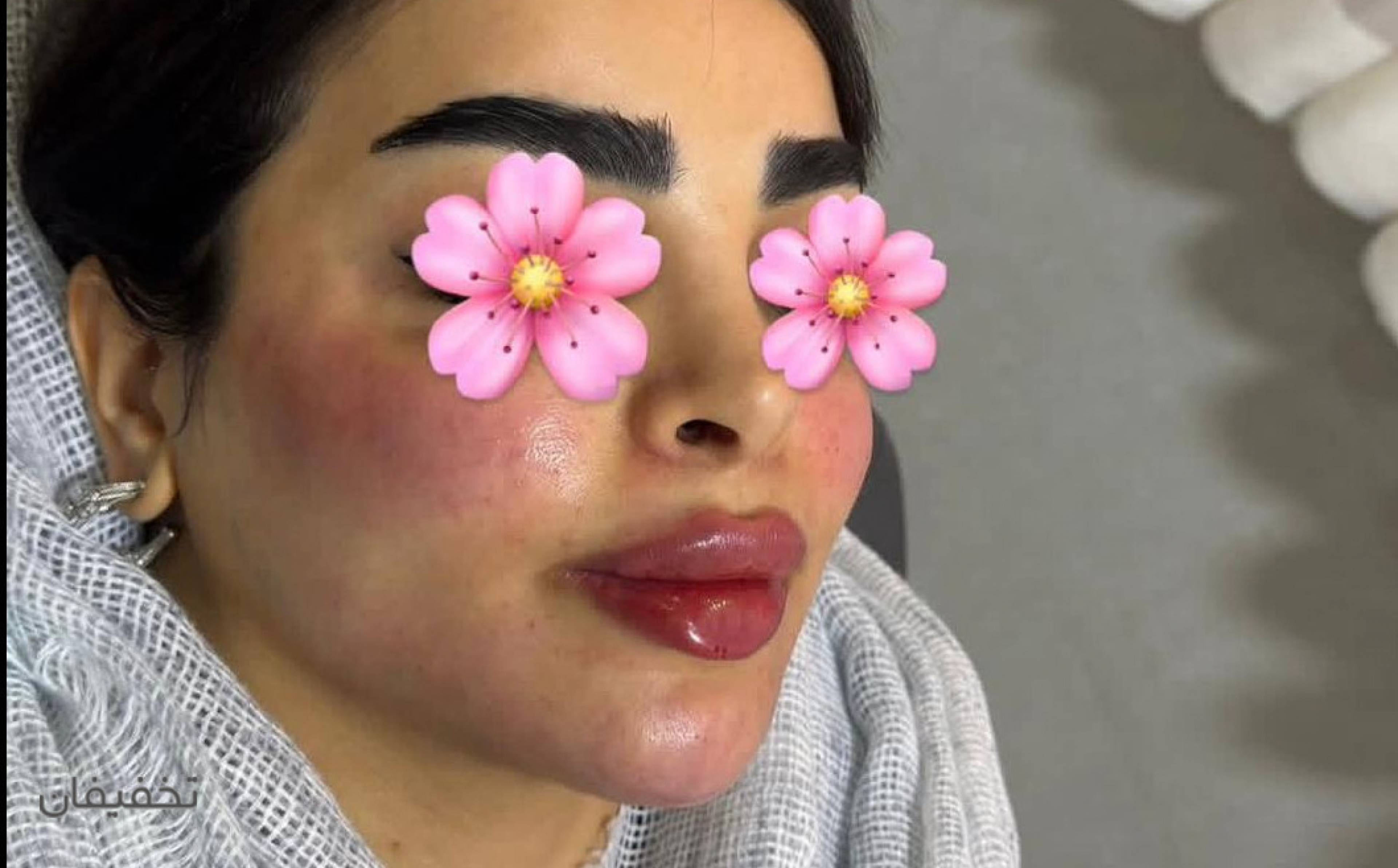 لیزر اسکلپیون مدیو استار و کندلا در مرکز ثنا