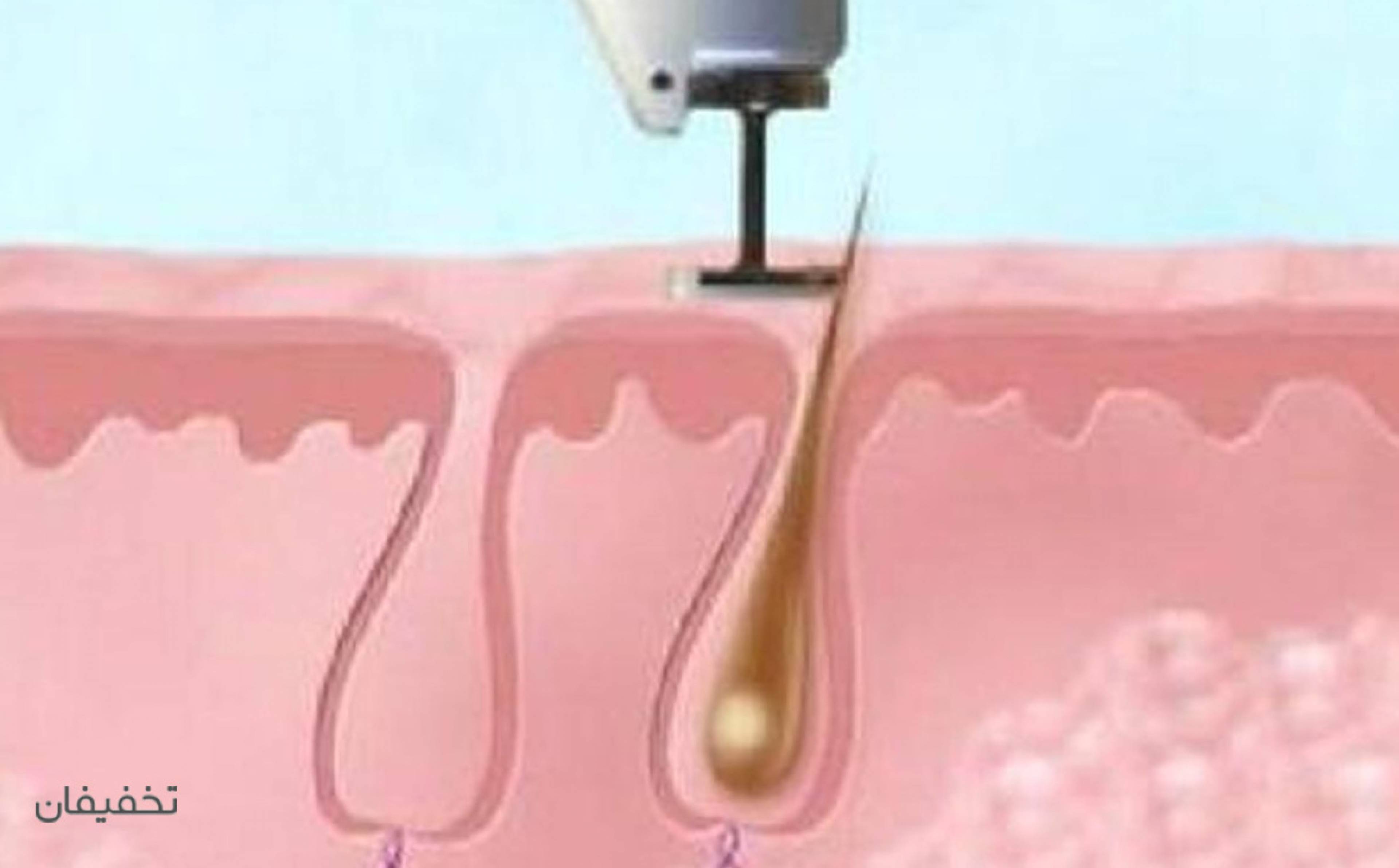 مطب مهر  