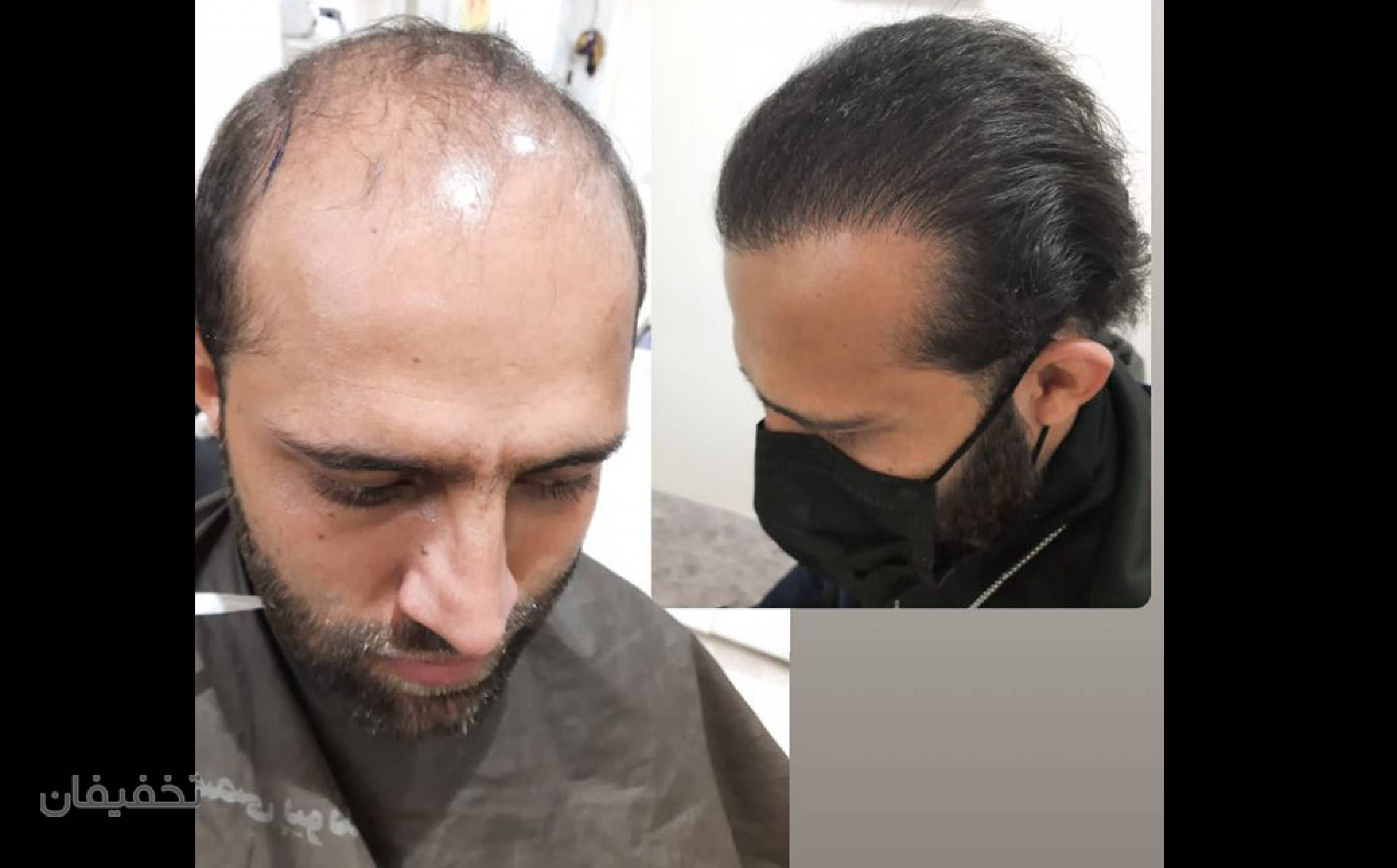 کیلینیک فوق تخصصی کاشت مو و کاشت ابروی سان شیدا
