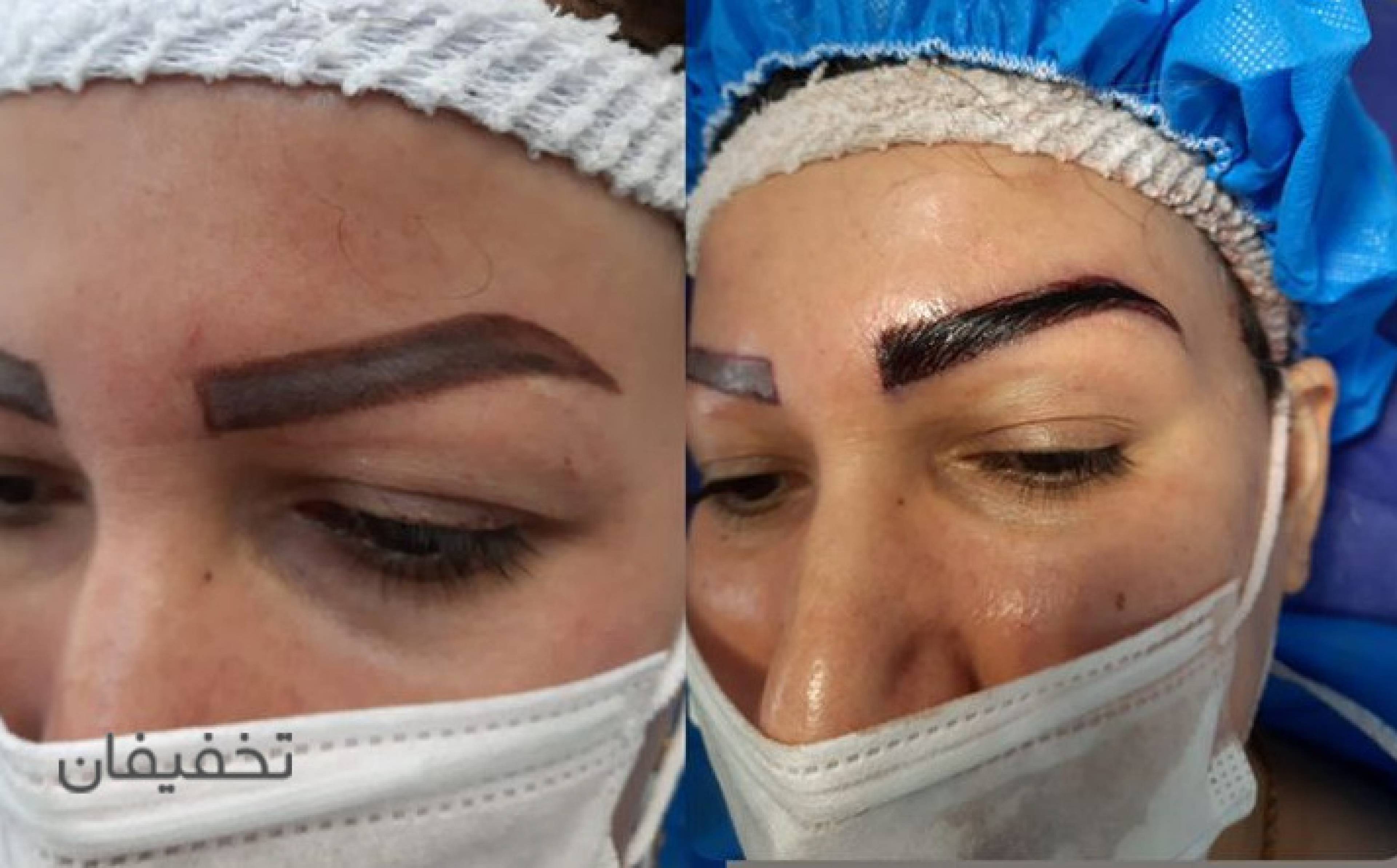 کیلینیک فوق تخصصی کاشت مو و کاشت ابروی سان شیدا