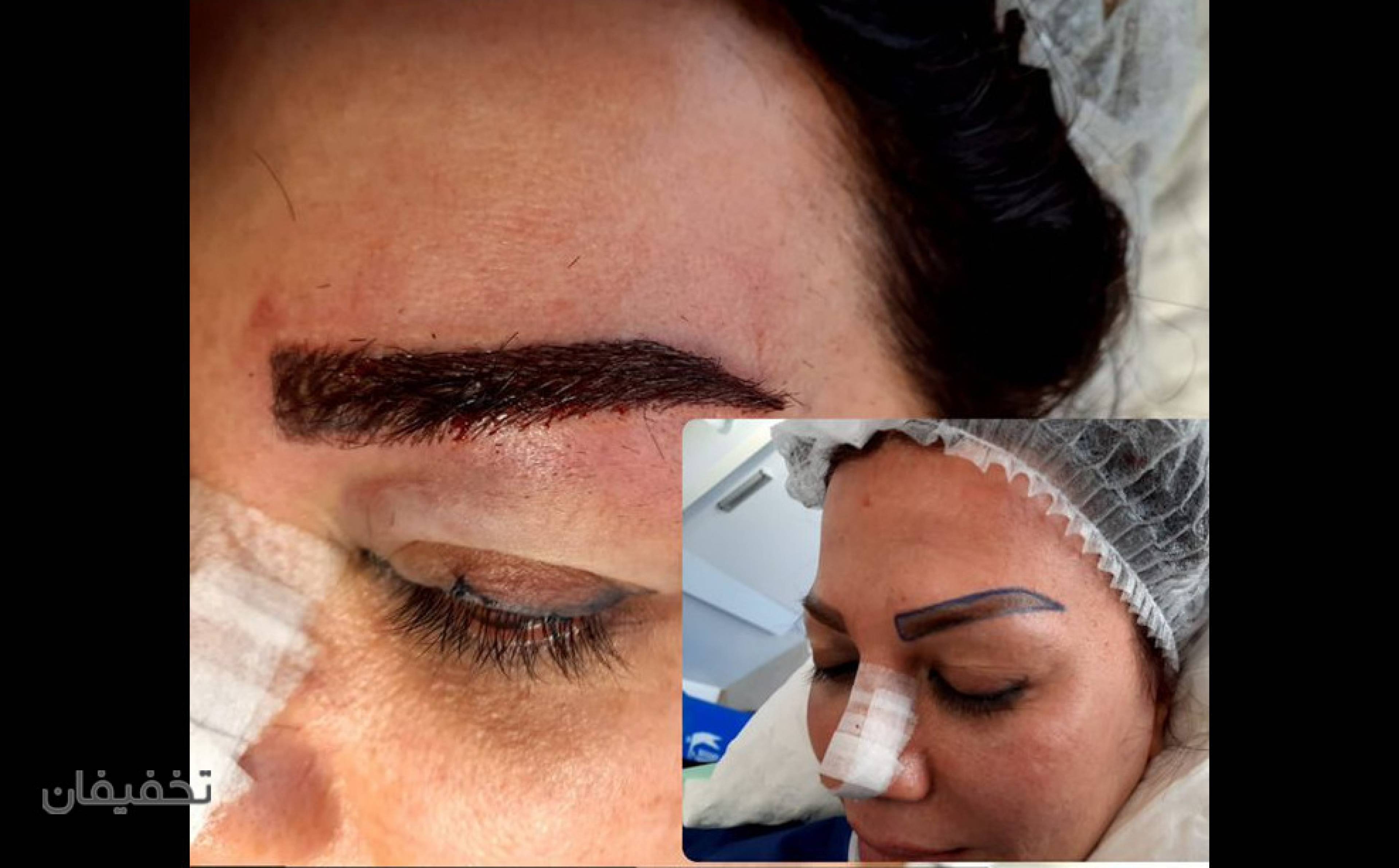 کیلینیک فوق تخصصی کاشت مو و کاشت ابروی سان شیدا