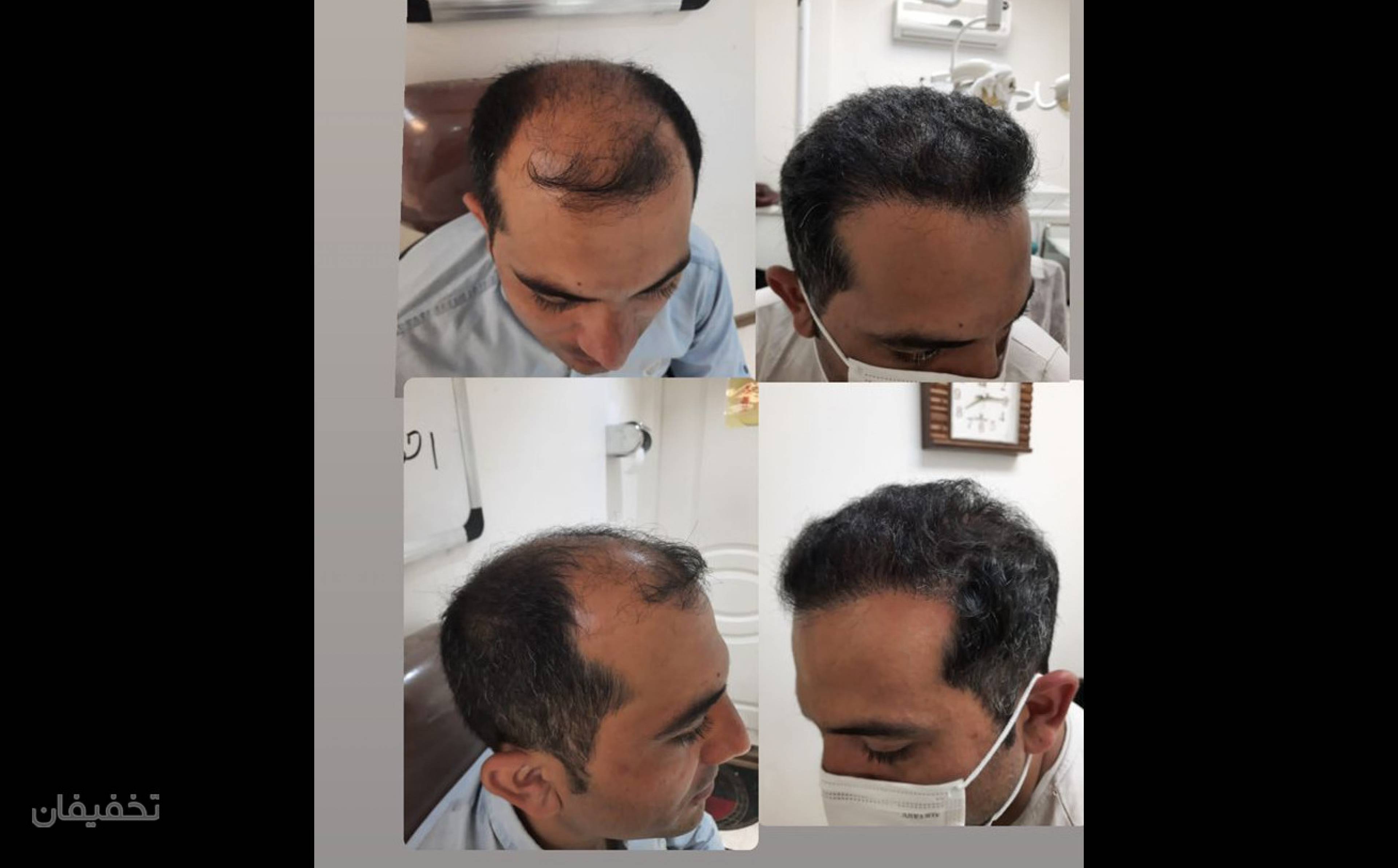 کیلینیک فوق تخصصی کاشت مو و کاشت ابروی سان شیدا
