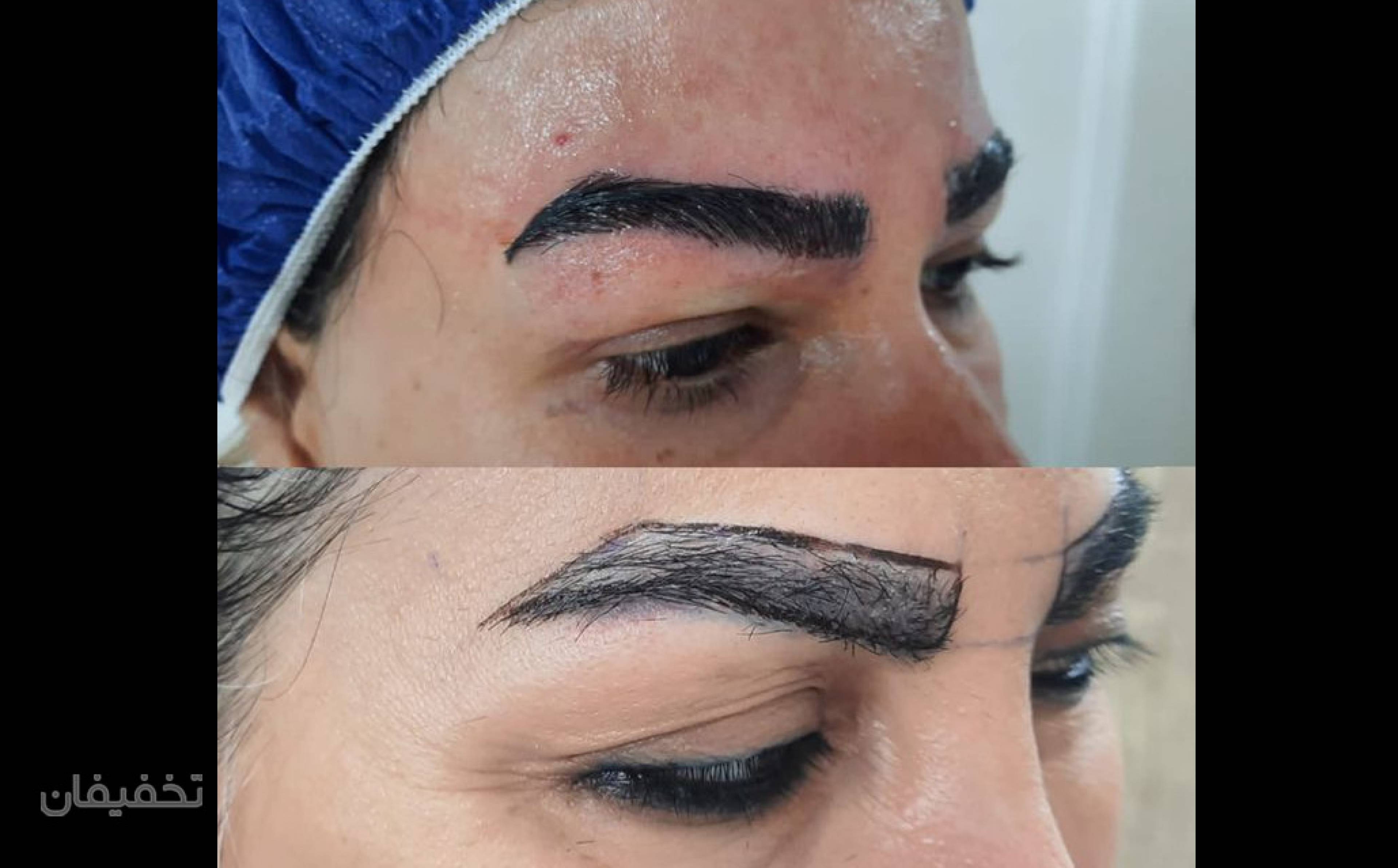 کیلینیک فوق تخصصی کاشت مو و کاشت ابروی سان شیدا