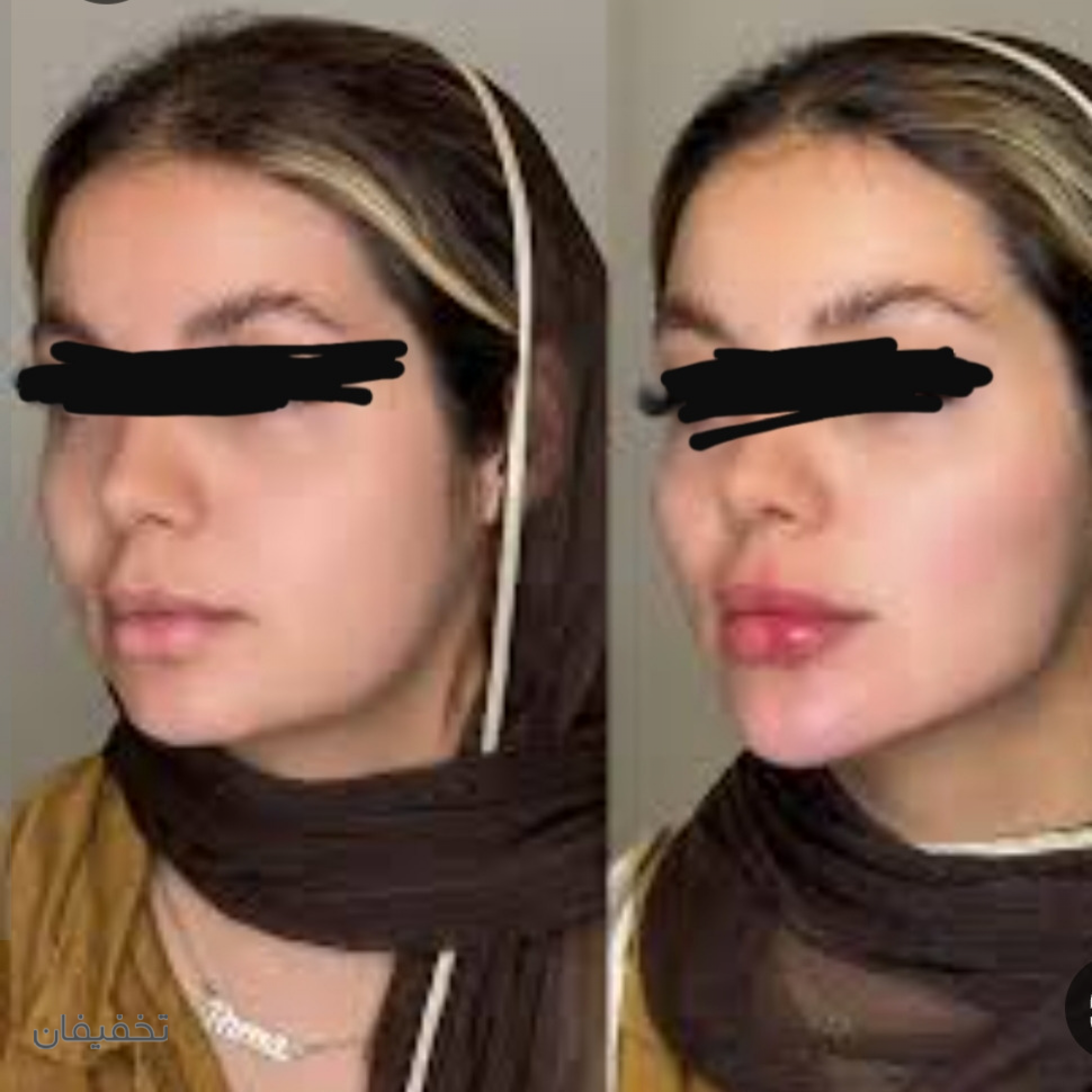 مرکز تخصصی کانتورینگ صورت آیرا