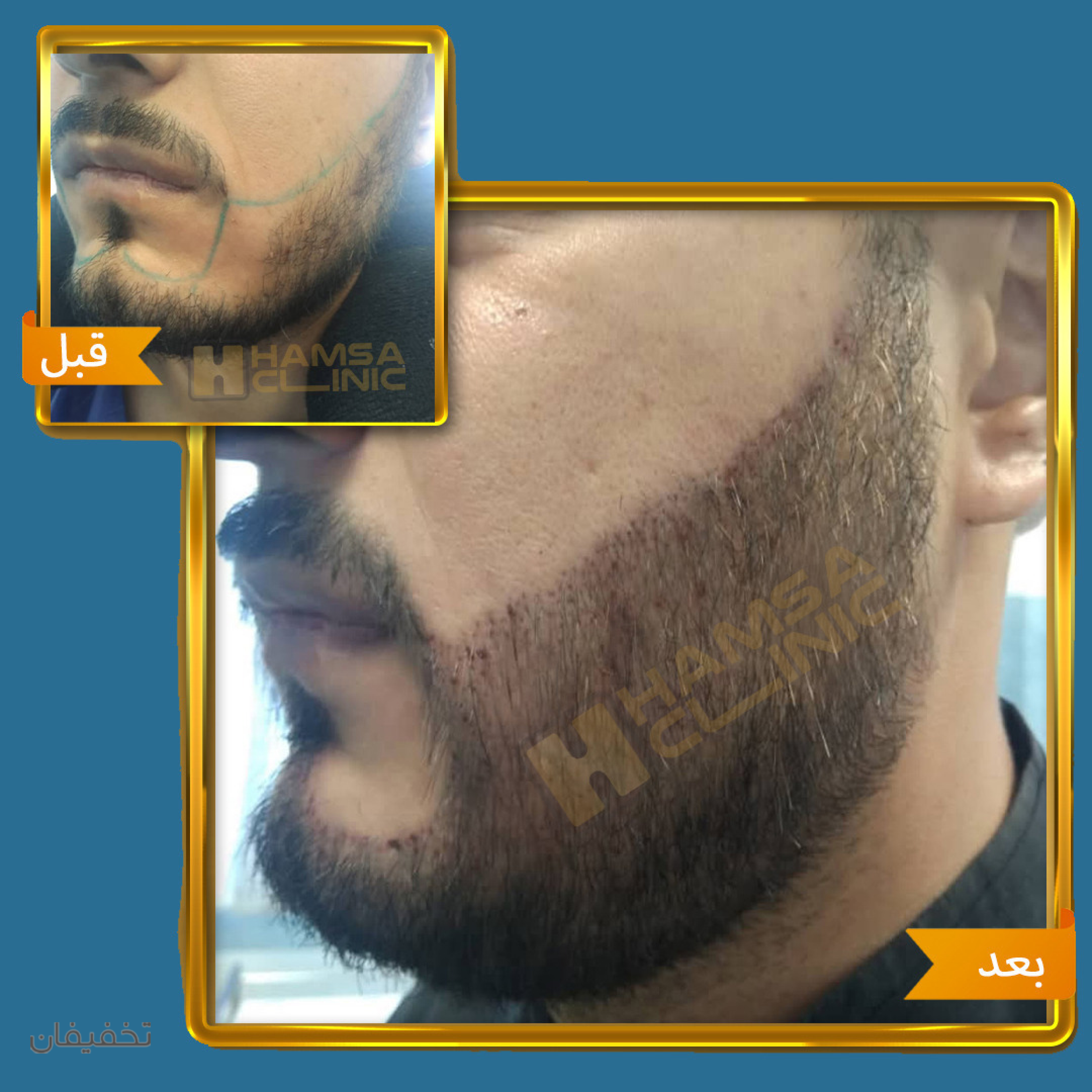 کلینیک کاشت مو و زیبایی همسا