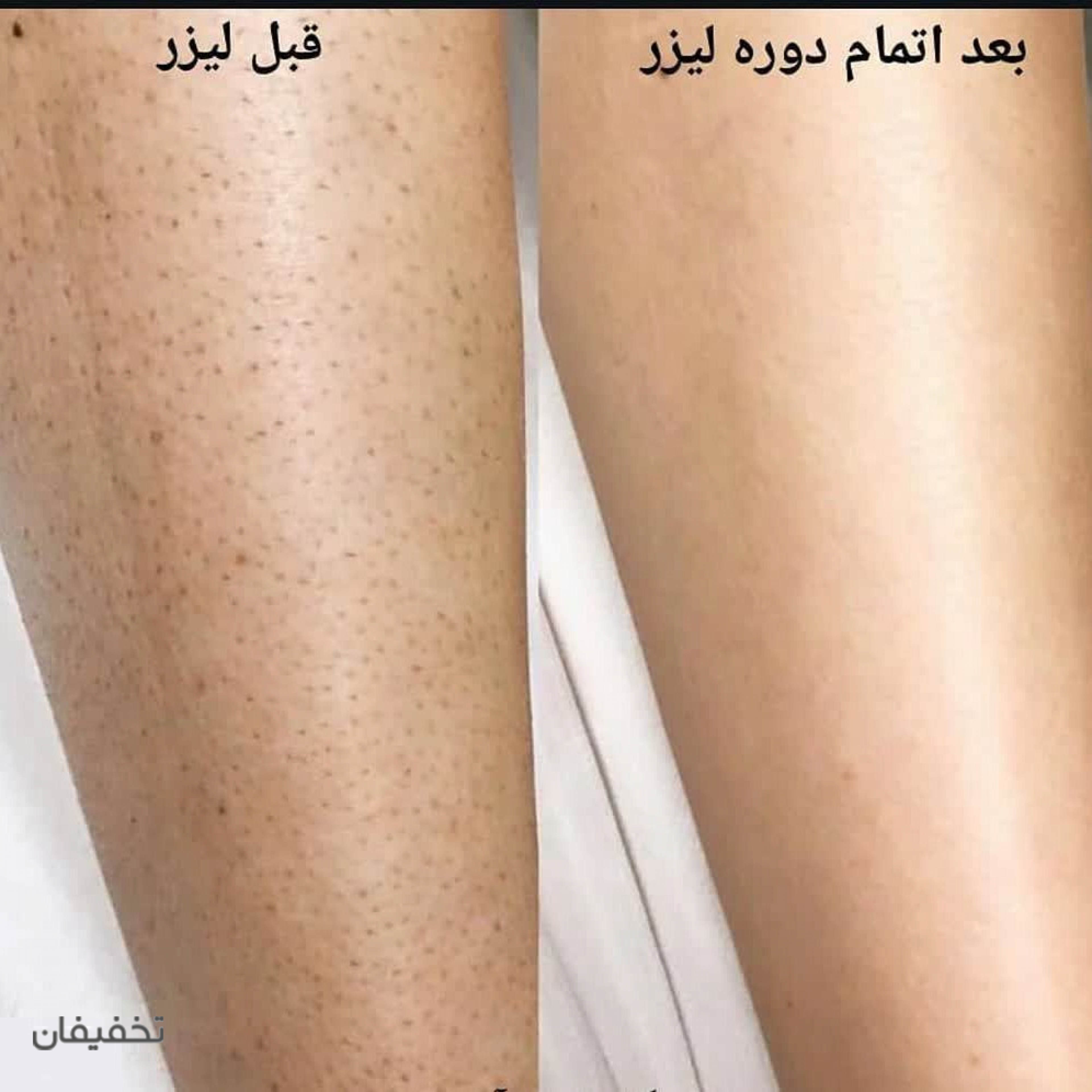  مطب زیبایی و لیزر موهای زائد رز