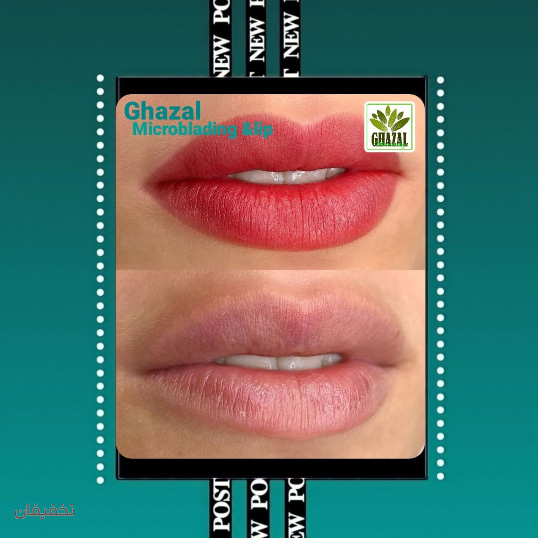 میکروبلیدینگ و شیدینگ لب غزل
