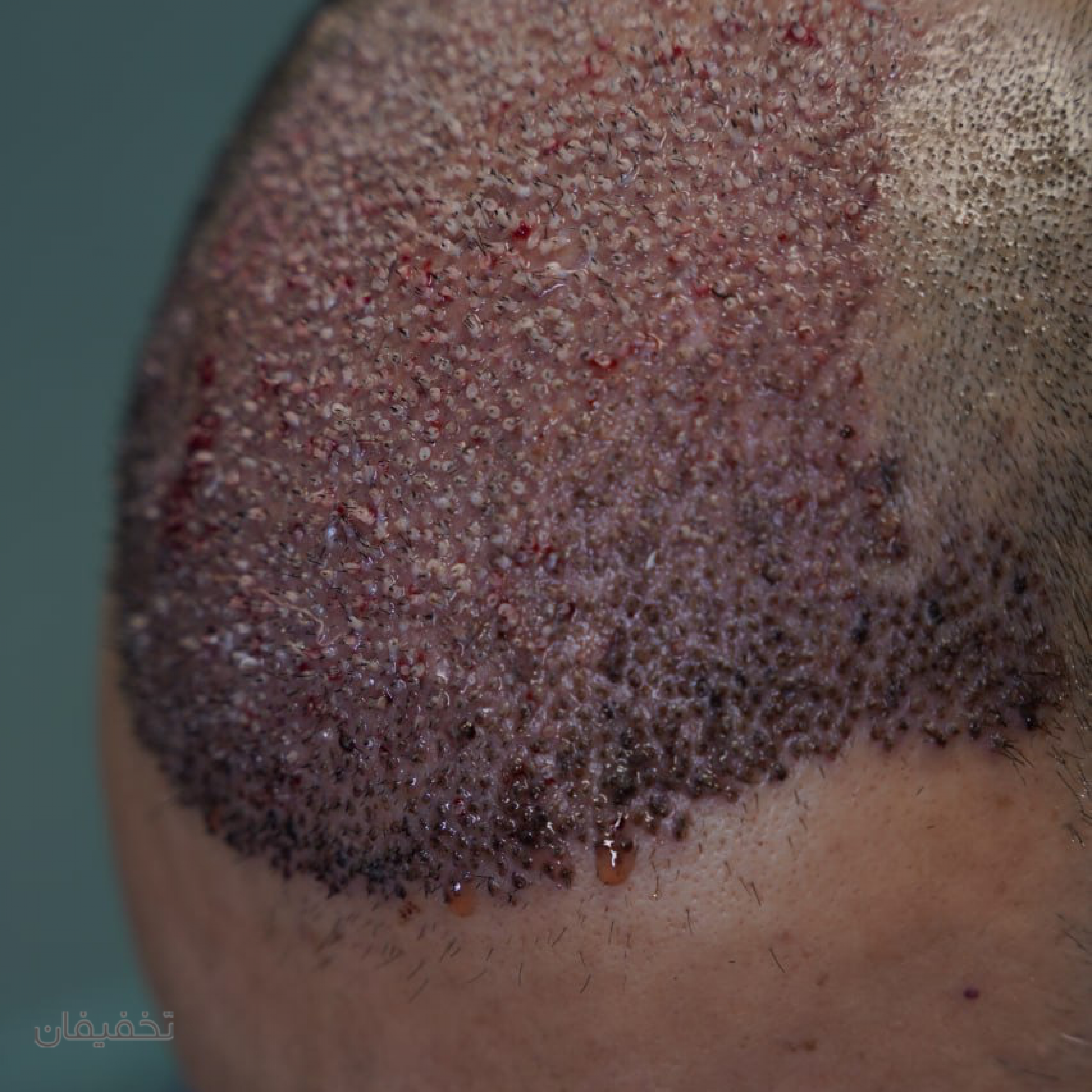 تیم کاشت مو بیوفول